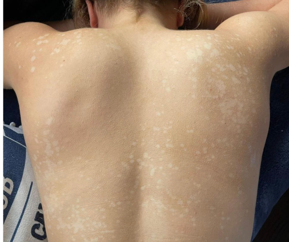 tinea versicolor treatment whitehouse tx